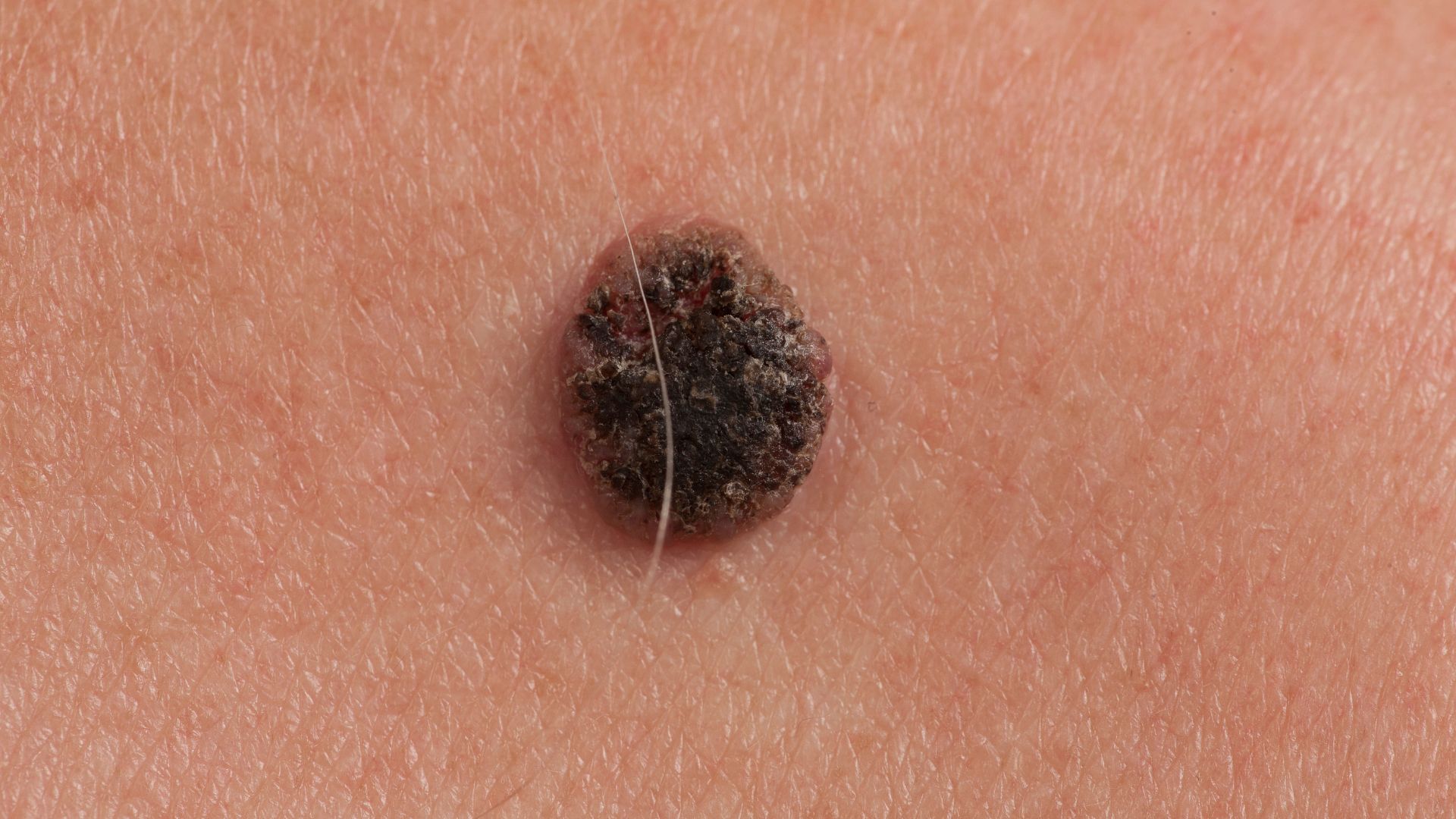 Skin Cancer Classification: Malignant vs. Benign